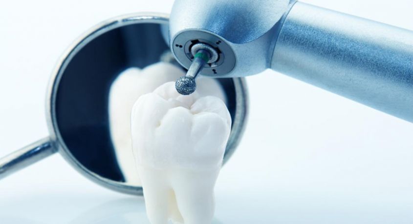 Скидка 60% на лечение кариеса в стоматологии «VivaStom».