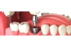 Имплант жевательного зуба