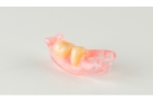 Иммедиат протезы на 1-3 зуба