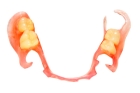 Иммедиат протезы на 4-6 зубов