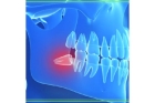 Иссечение гипертрофированной десны в области 1-го зуба