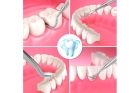 Снятие зубных отложений ручным и механическим способом
