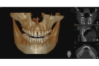 Двухмерная компьютерная томография челюсти (КТ 2D)
