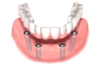 All-on-4 Протезирование зубов полными съемными пластиночными протезами с опорой на 4 имплантата