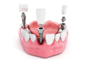 Импланты зубов в рассрочку