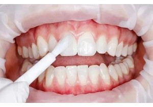 Глубокое фторирование эмали зубов 1 зуб
