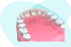 Снятие ретейнера, повторная его фиксация в области одного зуба