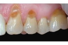 Лечение клиновидного дефекта зуба 