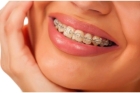 Сапфировые брекеты American Orthodontics на 1 челюсть
