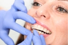 Удаление композита и полировка 1 зуба