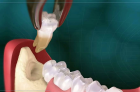 Удаление ретинированного, дистопированного зуба