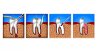 Гемисекции зуба