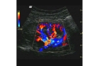УЗИ органов малого таза (комплексное) с допплеровским картированием