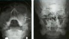 Рентгенография скуловых костей
