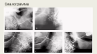 Контрастная рентгенография протоков слюнных желез
