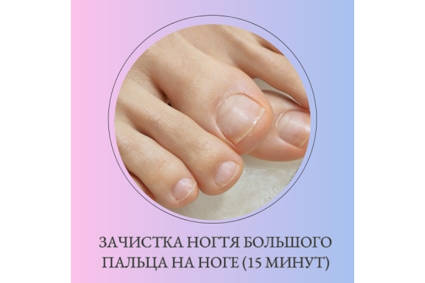 Зачистка ногтя большого пальца на ноге
