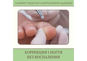 Коррекция вросшего ногтя без воспаления