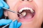 Лечение пульпита 1-но канального зуба