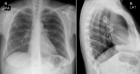 Рентгенография органов грудной полости