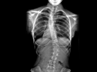 Рентгенография грудного отдела на сколиоз