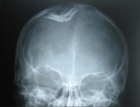 Рентгенография основания черепа
