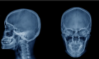 Рентгенография черепа