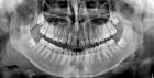 Рентгенография нижней челюсти