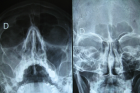 Рентген гайморовых пазух с контрастом 