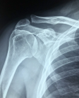 Рентген плечевого сустава 