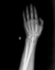 Рентгенография лучезапястного сустава 