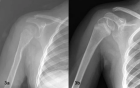 Рентгенография плечевого сустава 