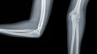 Рентгенография локтевого сустава