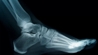 Рентгенография пяточных костей