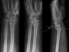 Рентген лучевой кости