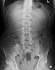 Рентгенография брюшной полости 