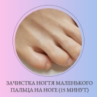 Зачистка ногтя маленького пальца на ноге